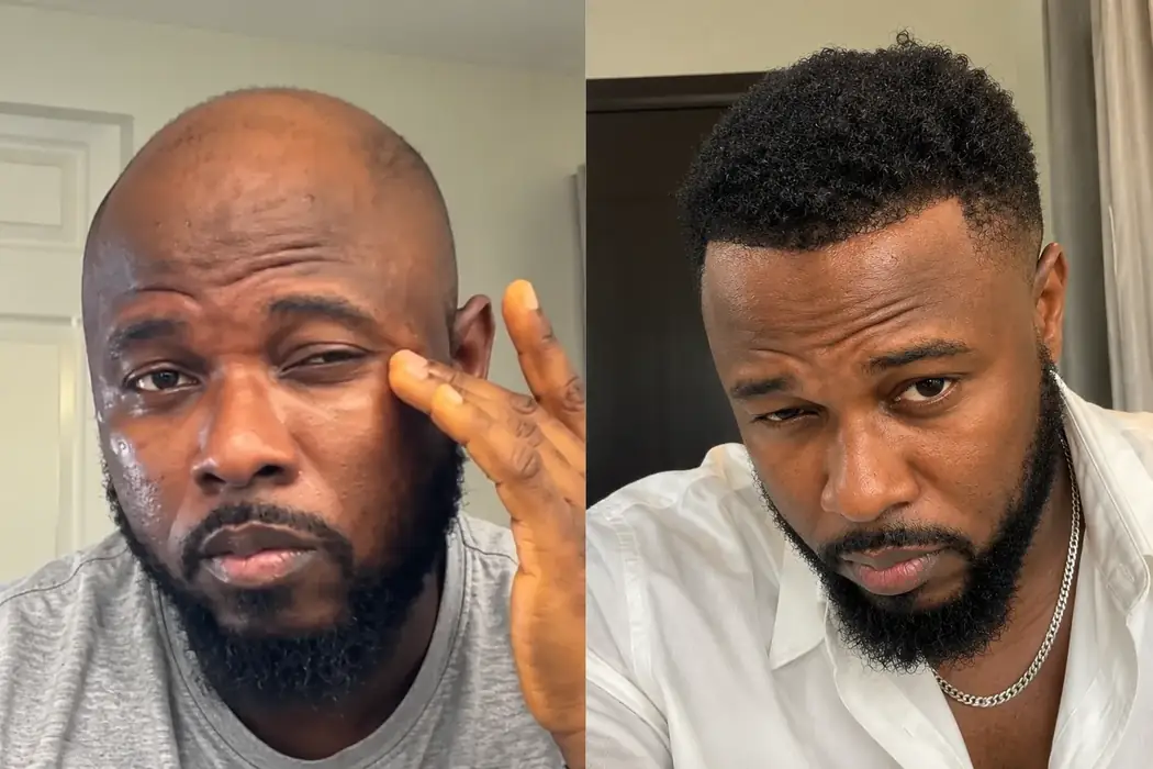 Male bald to restored hair before and after result