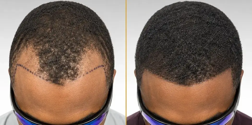 Top view hairline restoration before and after result