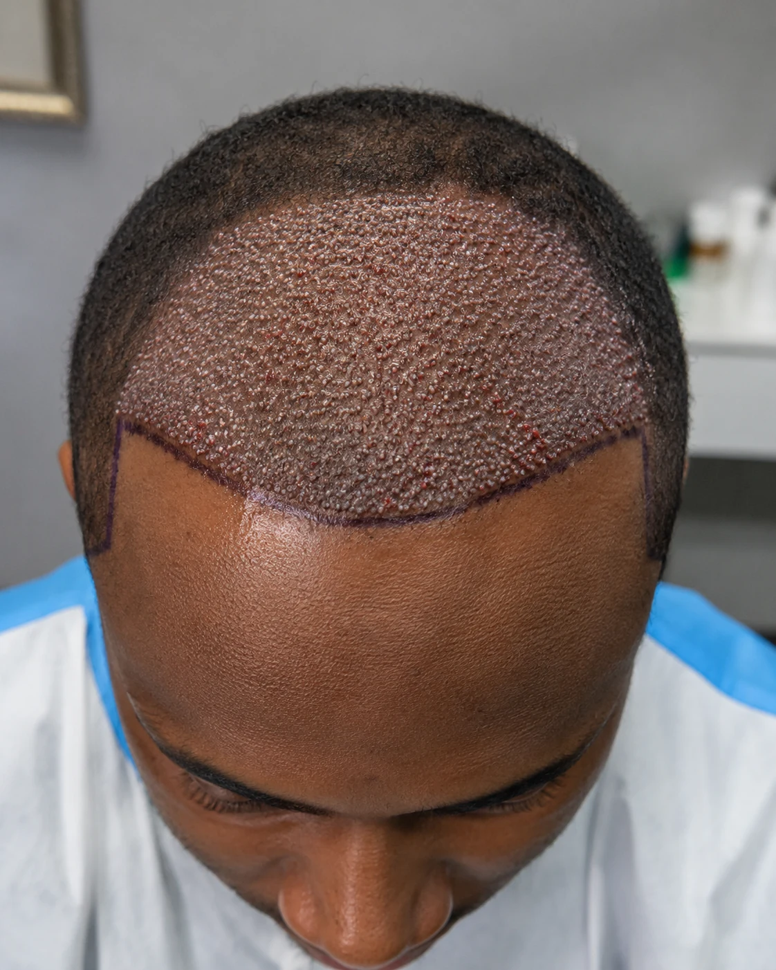 Hair Transplant at LUMINA